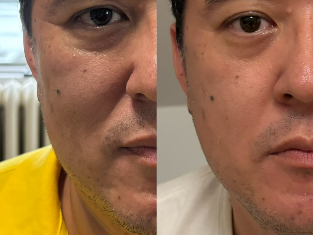 Before and after, 4 weeks — man, mid-40s, under-eye & cheek (unretouched)