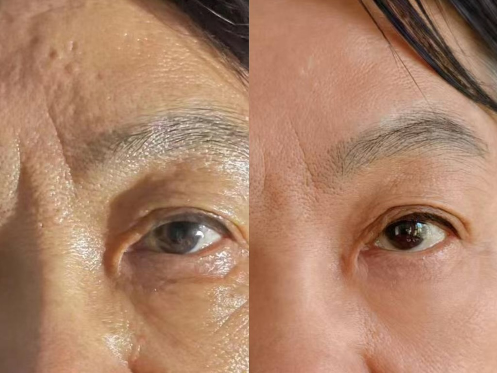 Before and after, 4 weeks — woman, 50s, eye area (unretouched)
