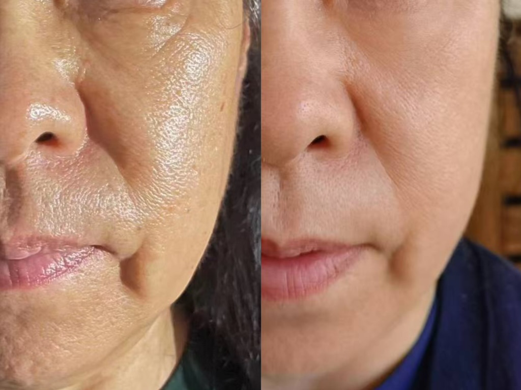 Before and after, 4 weeks — woman, 50s, cheek & smile lines (unretouched)