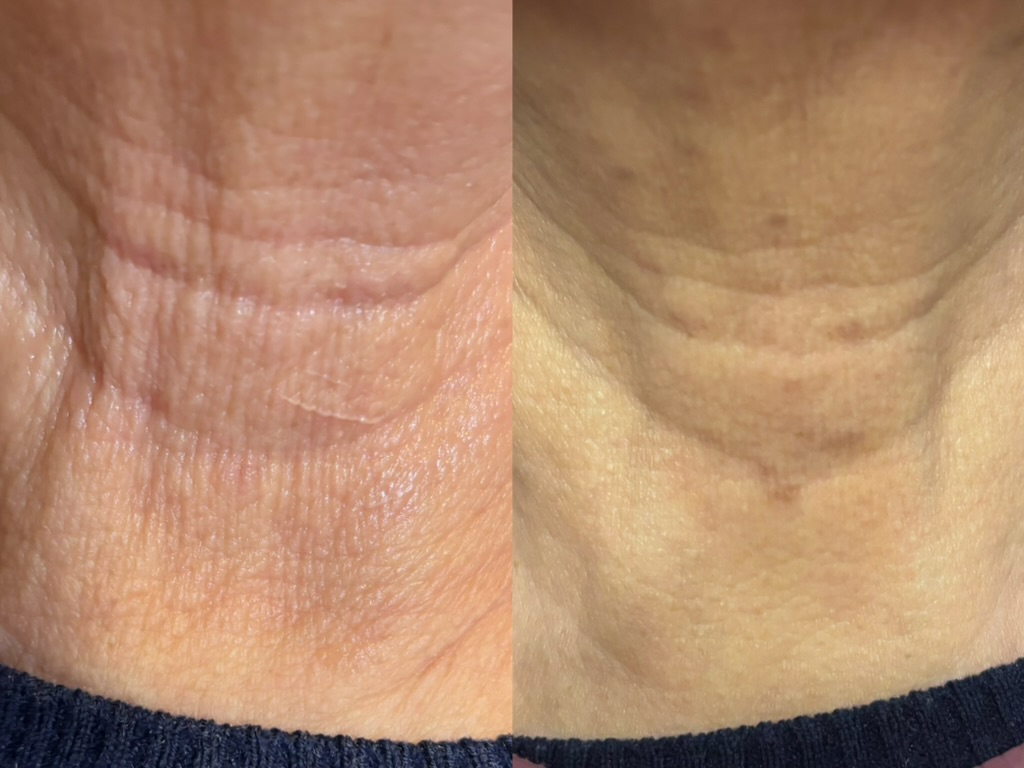 Before and after (unretouched)